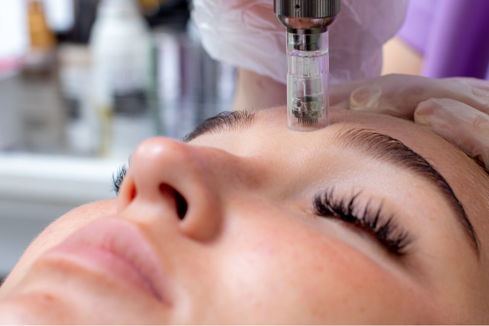 Fractional microneedling facial therapy